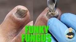HAVE NAIL FUNGUS? YOU NEED TO BE DOING THIS!!!! ***SUPER IMPORTANT TIP*** 