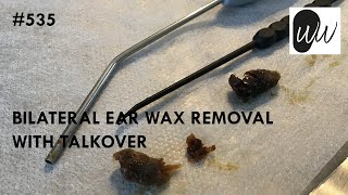 535 - Bilateral Blocked Ear Wax Removal with Talkover