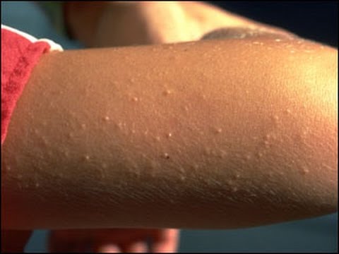 dermtv---itchy-bumpy-red-skin-(chicken-skin-or-keratosis-pilaris)-[dermtv.com-epi-#161]