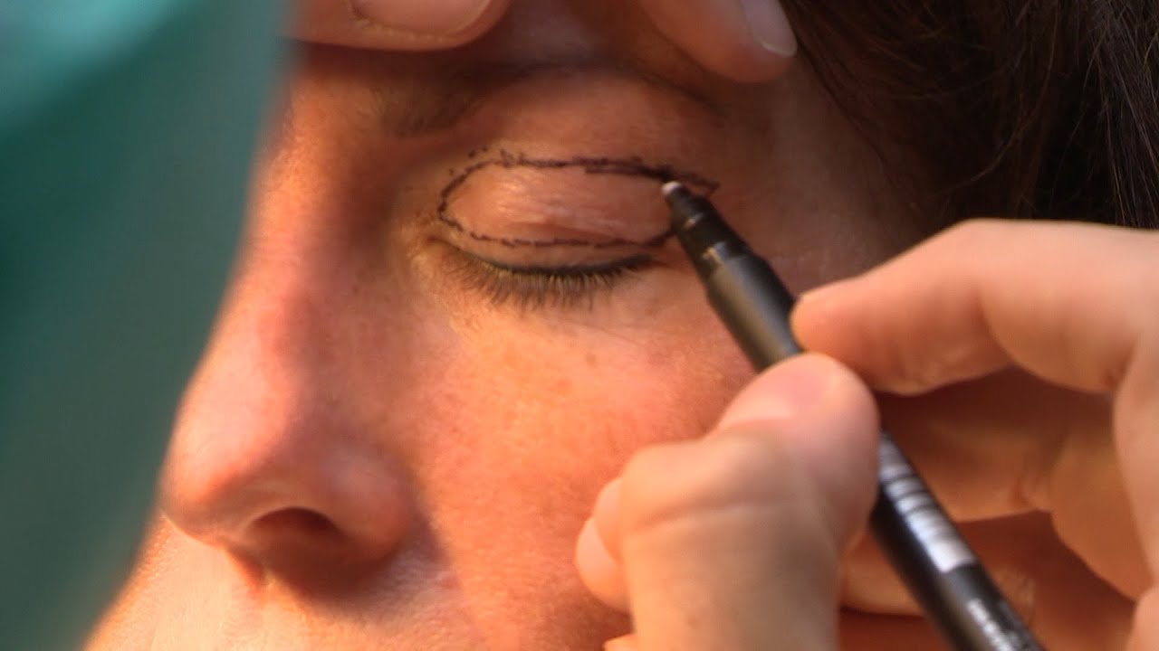 Bovenooglidcorrectie operatie | ABC Clinic