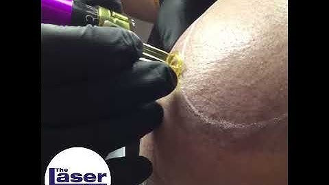 Scalp Micropigmentation Hairline adjustment/ softening by Laser at The SMP Removal Clinic