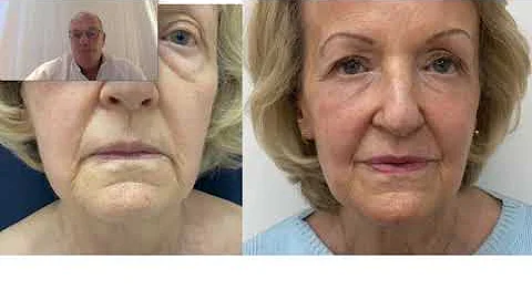 Laser Blepharoplasty Hoogstra Technique (21168)