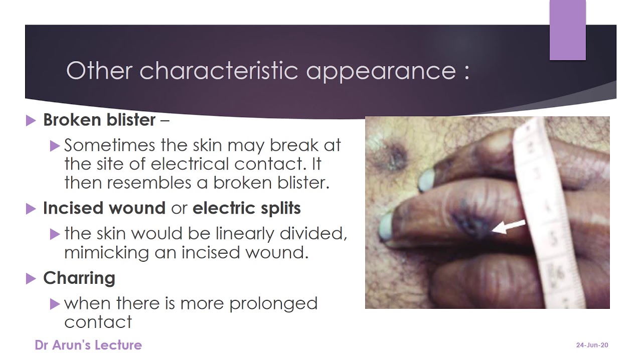 Joule burns FMT 2.25 CBME FAQ elearnerdeck YouTube