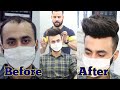 Hair Patches For Men | Hair Transformation | Hair Wig For Men | Natural hair line front lace patch..