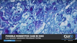 Ohio Health Department Identifies Probable Monkeypox Case, No Cases Reported In Michigan