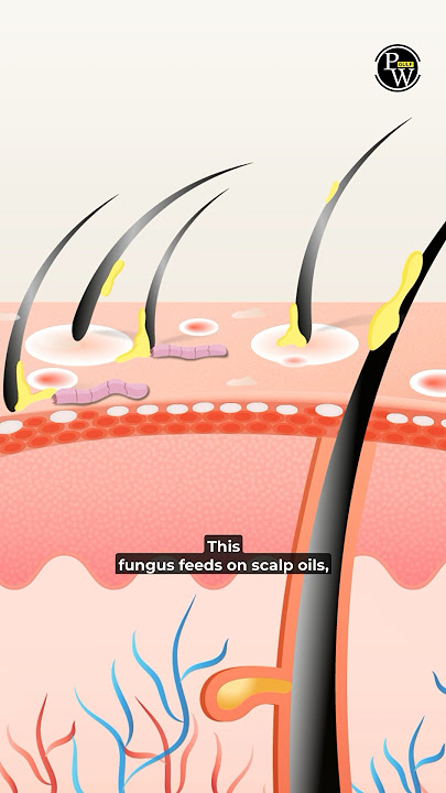🤯 What!!! There Are Worms in All Our Hairs? 😱 | What Causes Dandruff | #Dermatology #PW #Shorts