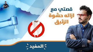 الاسنان وحشوة الزئبق/ قصتي لخلع الحشوه ونصيحتى لك. المختصر المفيد