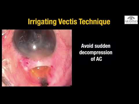 Episode 5 : Nucleus delivery and Cortex aspiration in MSICS