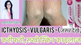 स्किन पे क्रैक्स—?Icthyosis रूखी स्किन?(Best homeopathic Medicine For Icthyosis vulgaris|-Dr.Rukmani