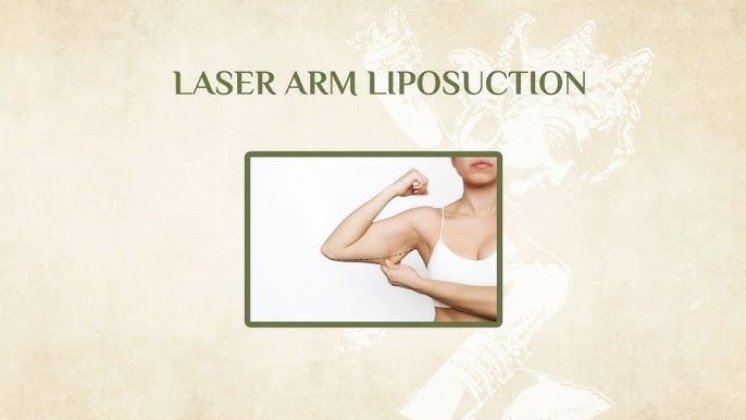 Arm Liposuction Transformation