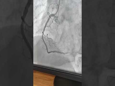 Primary angioplasty in