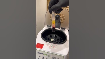 PRP which is Platelet Rich Plasma mixed with 40mg of Hyaluronic Acid #prp #hyaluronicacid #drsknn