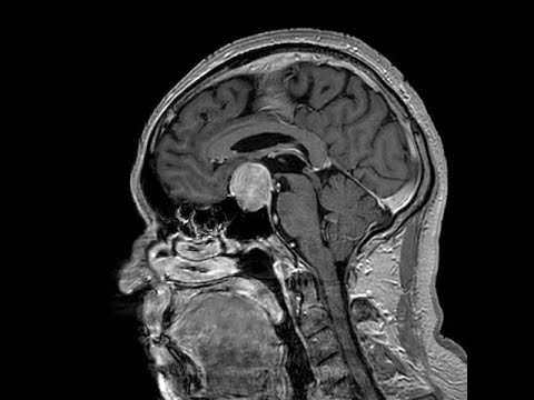 Tumores hipofisiarios. Neurociencias