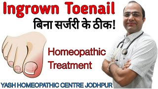 Ingrown Toe Nail |Onychocryptosis | Pain swelling Pus treatment without surgery