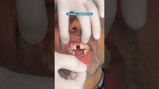 Implant in a Day #missing teeth #smilerestoration #music #shorts #india