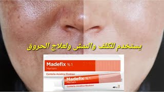 Madefix %1  لعلاج التصبغات الجلدية والكلف والنمش To treat skin pigmentation, melasma and freckles