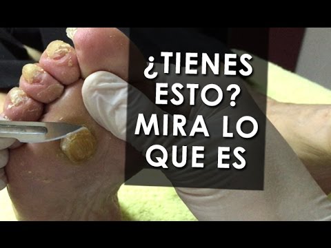 Vídeo: Diferencia Entre Maíz Y Callos