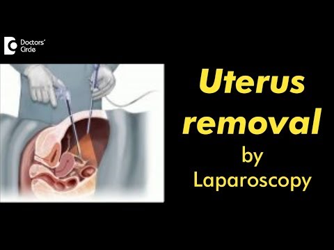 Video: Uterul poate fi îndepărtat prin laparoscopie?