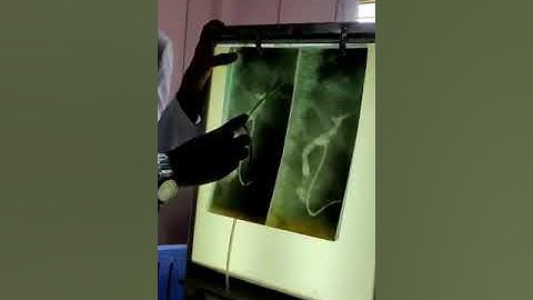 T Tube Cholangiogram