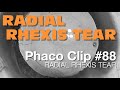 Phaco clip 88  radial rhexis tear