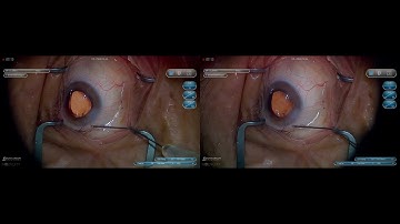 3D Surgery: Basics of Phacoemulsification: IOL Insertion & Wound Closure (Part 6/6)