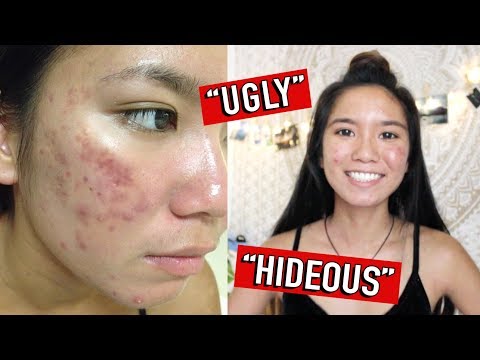 My Journey with Hormonal Cystic Acne | My Acne Treatment/Skincare Routine | Michelle Kanemitsu