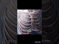 People don't understand until it happens to them #rami #winter #pneumothorax#viral #shorts#subscribe