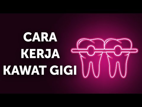 Video: Bagaimana Kawat Gigi Dipakai: Apa Yang Diharapkan Pada Hari Anda Mendapatkan Kawat Gigi