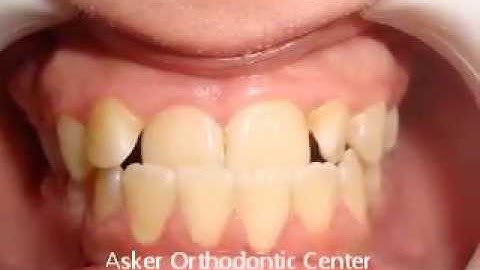 Acase report of orthodontic pseuo class III at Asker Orthodontic Center  by Dr.Amr Asker