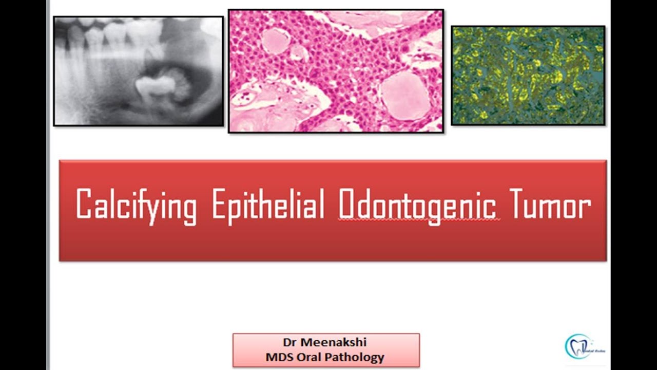 Calcifying Epithelial Tumor : Calcifying epithelial odontogenic tumor ...
