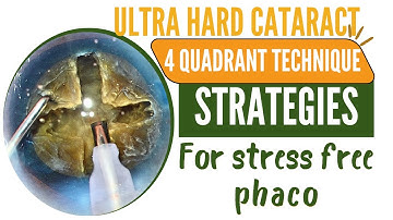 Ultra Hard Cataract- 4 quadrant technique  Strategies for stress free phaco.  Deepak Megur