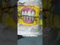Upper lower cast partial denture 😬😬😬#apexdental #splittooth #orthodontist #dentistry #partial