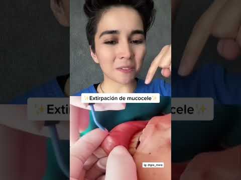 Video: ¿La sal ayuda al mucocele?