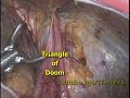 Inguinal hernia  tapp  with all landmarks demonstrated  no tacks