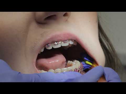 Aparat ortodontyczny czyszczenie zębów