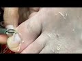 HOW TO CUT THICK TOENAILS - Toenail Cleaning Satisfying #243