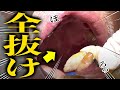 患者「歯がグラングランで痛くて もう、はよ抜いてーー!!!!!」糖尿病、高血圧etcで歯が抜けなくなった患者さんをHELPします Beatles 歯医者かおり