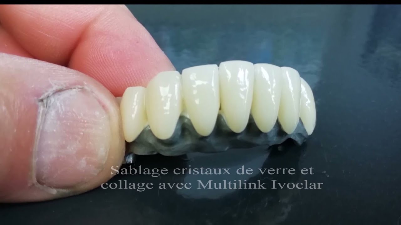 Bridge Implant avec Dents Zircon Full et Gencive Nanocéram par Dental Labo