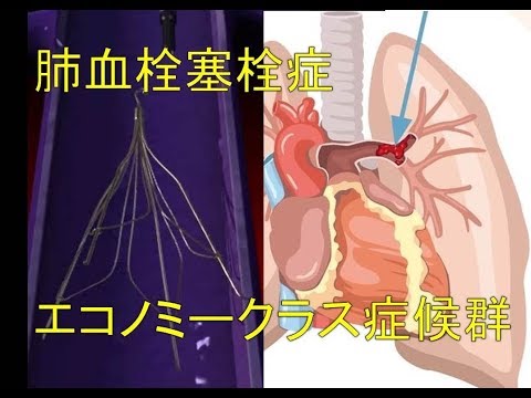 肺血栓塞栓症（エコノミークラス症候群）のカテーテル治療