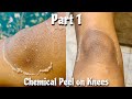 Chemical peel on knees part 1  tca chemical peel on knees chemicalpeel tcapeel tcachemicalpeel