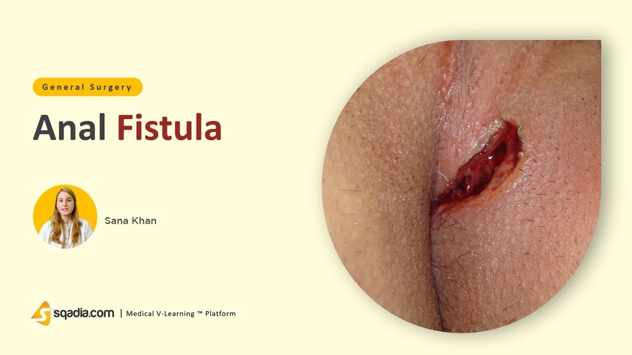 Anal Fistula Surgery