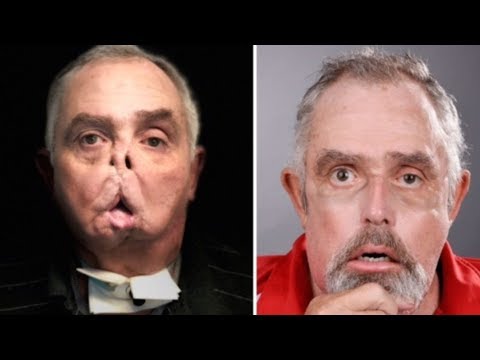 Man Risks His Life To Undergo Canada S First Face Transplant Youtube