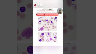 MORPHOLOGY: Chronic Lymphocytic Leukemia - CLL #hematology #medicine #morphology