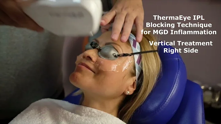 ThermaEye IPL Device and Treatment