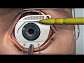 Lasik Surgery - 3D Medical Animation