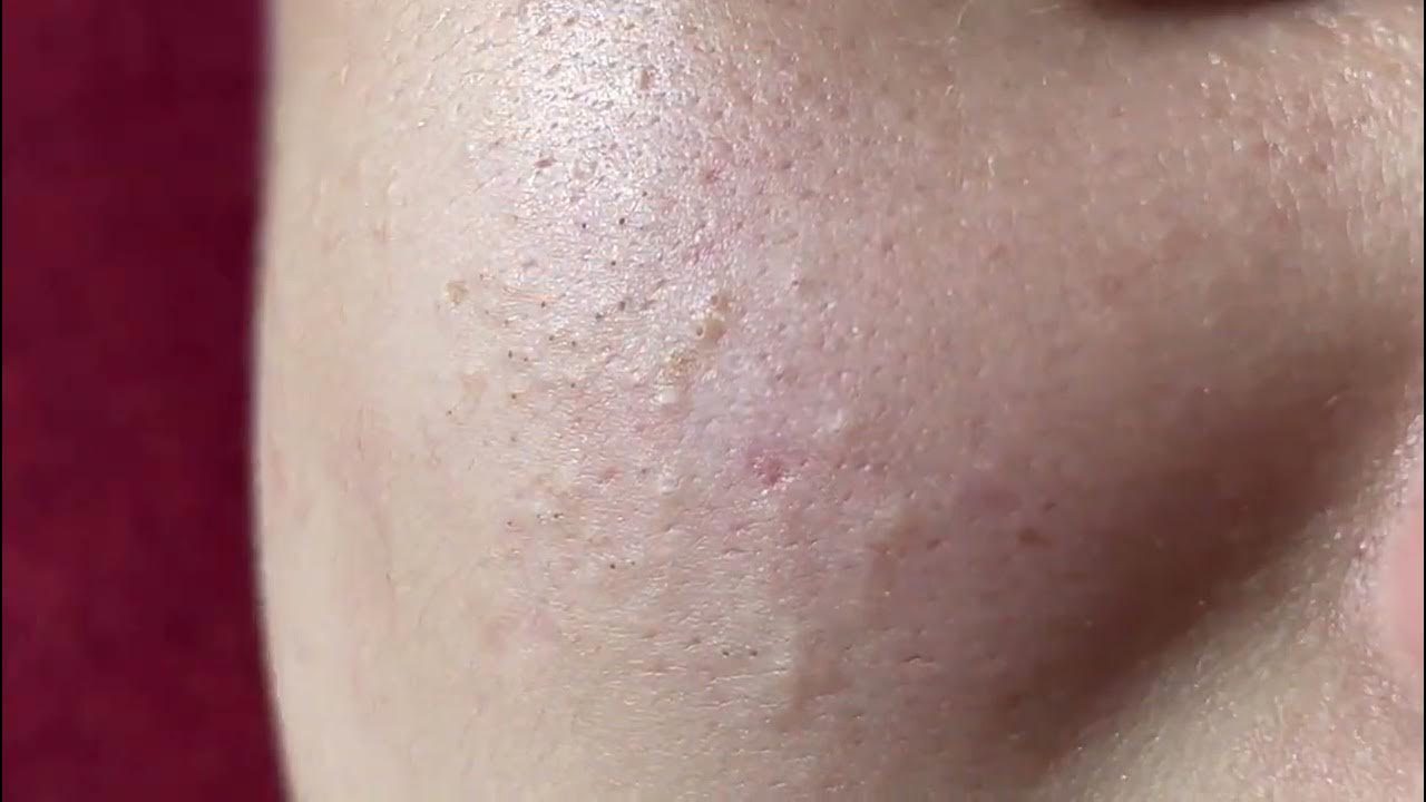 ACNE TREATMENT MAI NGOC DA NANG - YouTube