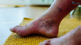 What Happens When Diabetes Is Not Controlled? | Must-Know Health Risks!