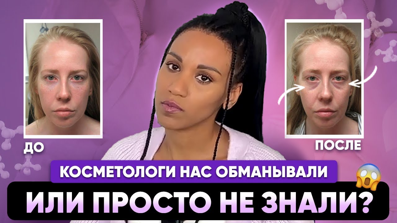 НОСОСЛЁЗНЫЕ БОРОЗДЫ - впадины под глазами: новые открытия анатомии, отсроченные осложнения 💉