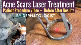 Acne Scars Laser Treatment | CO2 Laser Treatment For Acne Scars | Dermatologist | Dr Sunil Kothiwala