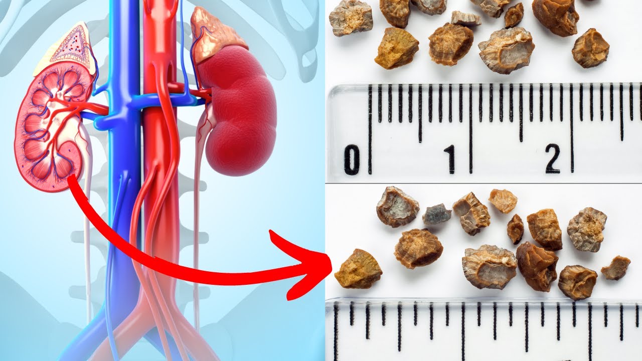Top 5 fruits that help break down kidney stones naturally youtube